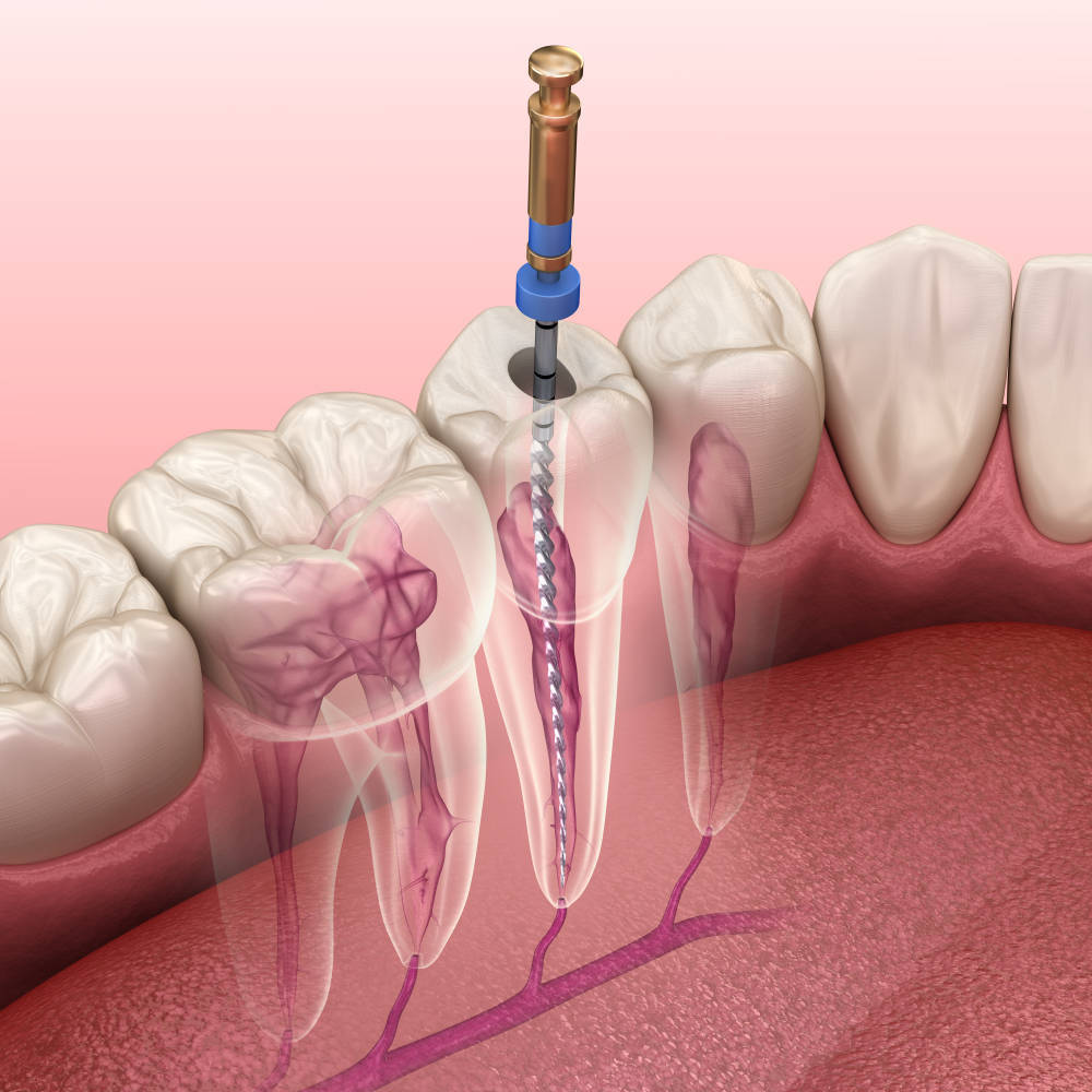 Endodoncia: ¿sabes qué es?