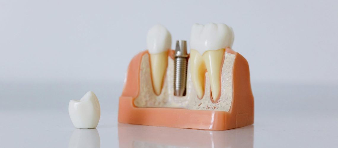 Soluciones avanzadas de la implantología dental